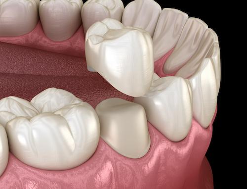 dental crown doreen vic
