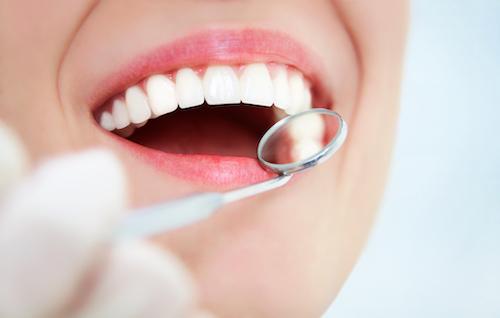 doreen vic veneers