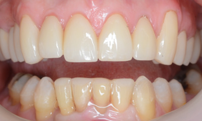 After treatment - Clear Aligners and Crowns/Veneers 