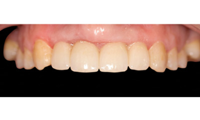 After treatment - Dental Implant and Bridge Treatment