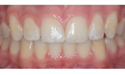 After treatment - Fixed Orthodontic Treatment