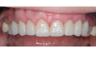 After treatment - Gum Lift, Crown and Veneers 