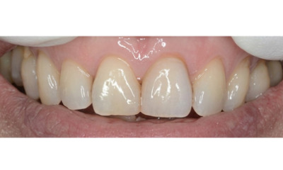 After treatment - Single Crown Colour Matching 