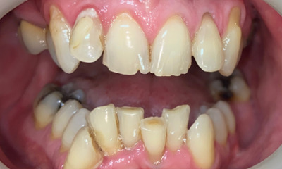 Before treatment - Clear Aligners and Crowns/Veneers 