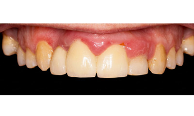 Before treatment - Dental Implant and Bridge Treatment