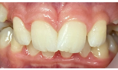 Before treatment - Fixed Orthodontic Treatment