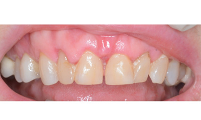 Before treatment - Gum Lift, Crown and Veneers 