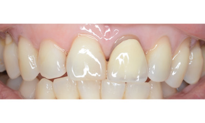 Before treatment - Single Crown Colour Matching 